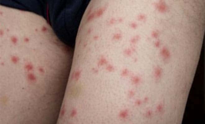 Аллергия на укусы клопов причины симптомы опасность реакция 03