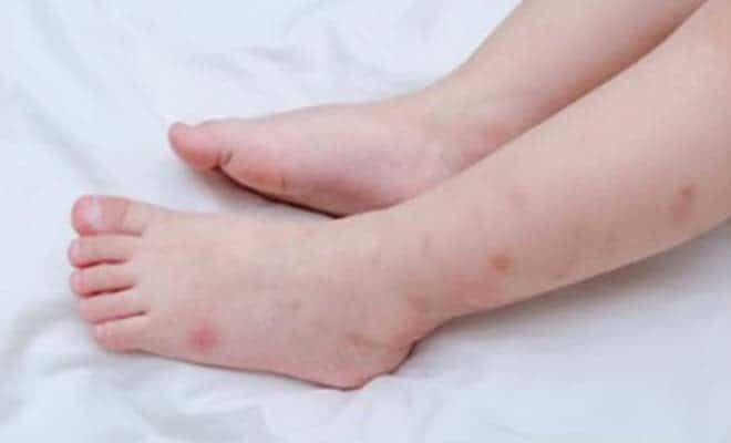 Аллергия на укусы клопов причины симптомы опасность реакция 05