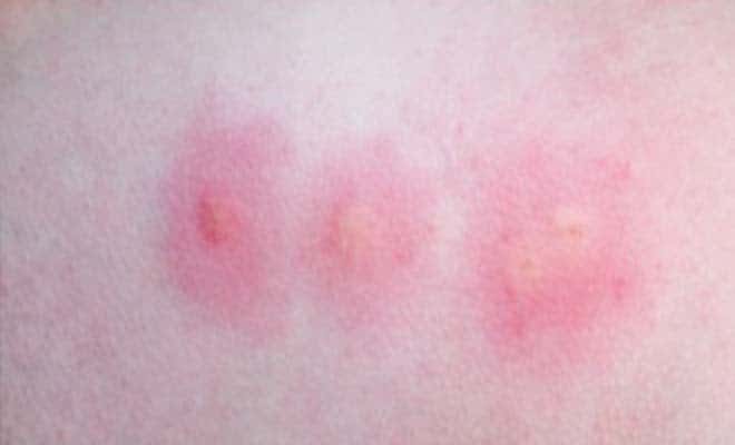 Аллергия на укусы клопов причины симптомы опасность реакция 06