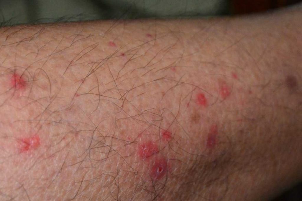 Чем опасны клопы для человека страшные болезни от паразитов повреждения на ноге
