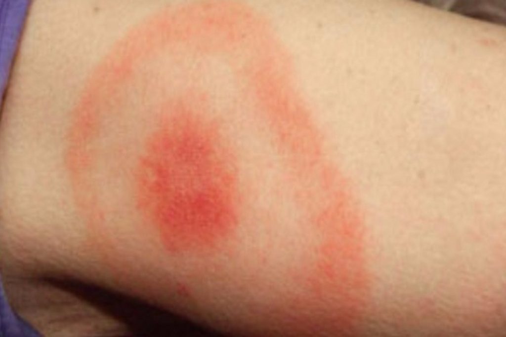 Повышение температуры тела после укуса клеща до 37°С – признак аллергии на укус или симптом опасного заболевания
