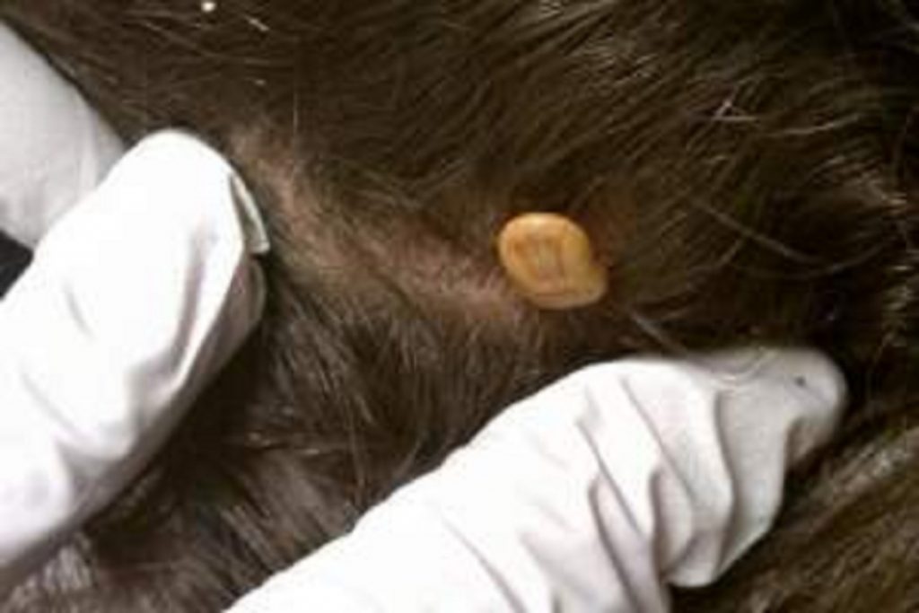 Виды клещей на голове в волосах – что делать, как бороться и как избавиться от самки иксодового клеща