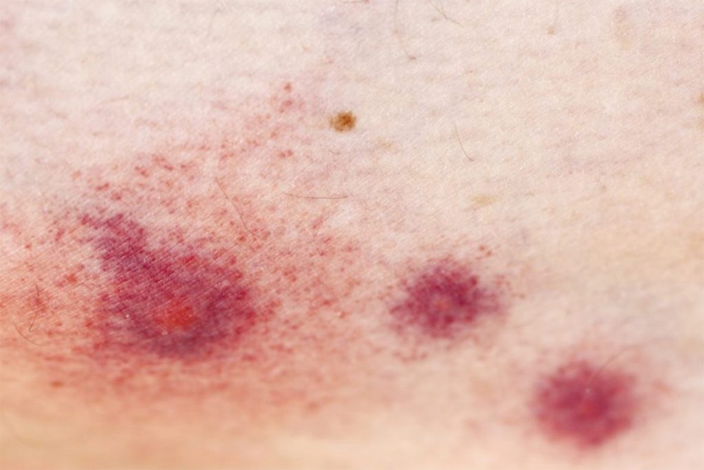 10 фото красных пятен и покраснений после укуса клеща клещевой энцефалит