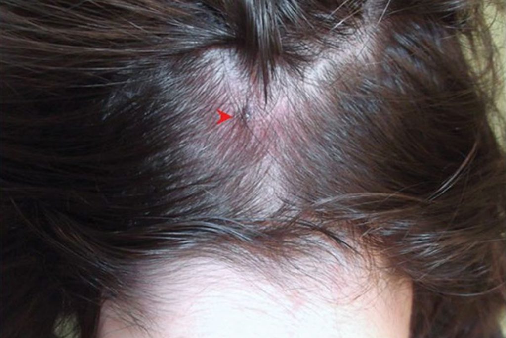5 шагов для определения – что вас точно укусил клещ реакция на укус в кожу головы