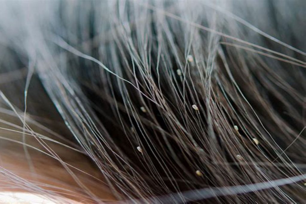 Гниды на волосах: что это, как выглядят, откуда берутся и чем лечить - фото
