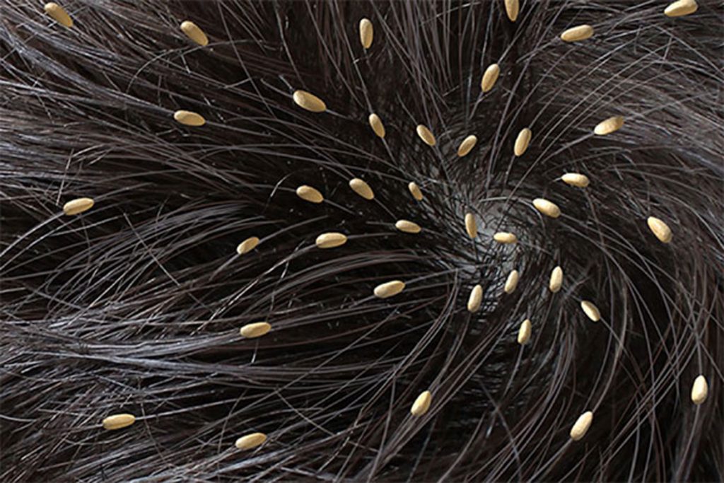 Гниды на волосах: что это, как выглядят, откуда берутся и чем лечить - мертвые или живые 