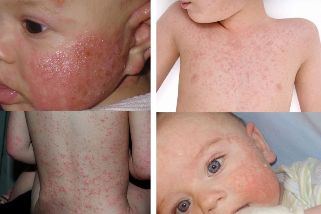 Алгоритм лечения аллергии на пылевого клеща - у детей