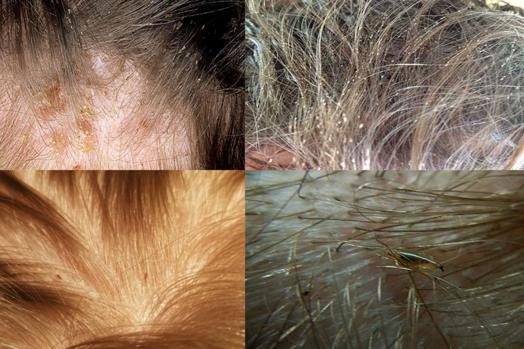 Как выглядят укусы бельевых, головных, платяных, лобковых вшей, чем лечить и как долго чешутся - вши на голове