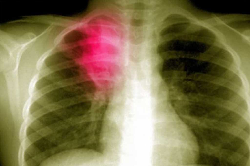 Пневмония - воспалительный процесс в тканях органов дыхания